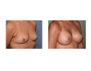 Sientra Textured Shaped Breast Implants Augmentation results oblique view Dr Barry Eppley Indianapolis