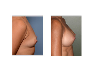 Sientra Textured Shaped Breast Implants Augmentation results side view Dr Barry Eppley Indianapolis