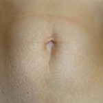 Stretch marks Dr Barry Eppley Indianapolis