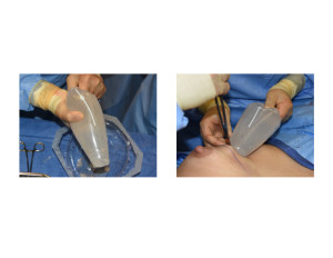 Textured Shaped Silicone Breast Implants Funnel Insertion Technique 2 Dr Barry Eppley Indianapolis