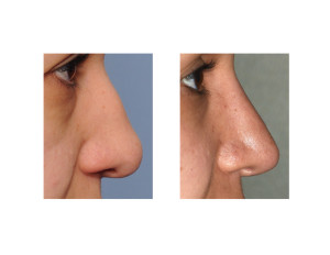 Thick Female Nose Rhinoplasty result Dr Barry Eppley Indianapolis