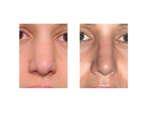 Thick Female Nose Rhinoplasty result side view Dr Barry Eppley Indianapolis