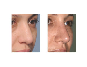 Thick Fermale Nose Rhinoplasty result oblique view Dr Barry Eppley Indianapolis