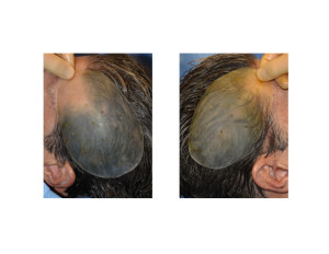 Bilateral Head Widening Skull Implants intraop Dr Barry Eppley Indianapolis