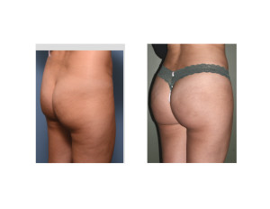Braziilan Buttock Lift results oblique view Dr Barry Eppley indianapolis