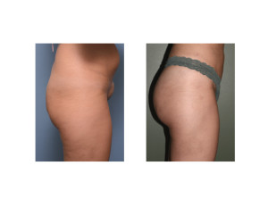 Brazilian Butt Lifts results side view Dr Barry Eppley Indianaoplis