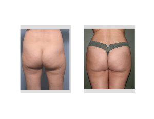 Brazilian Buttock Lifts result front view Dr Barry Eppley Indianapolis