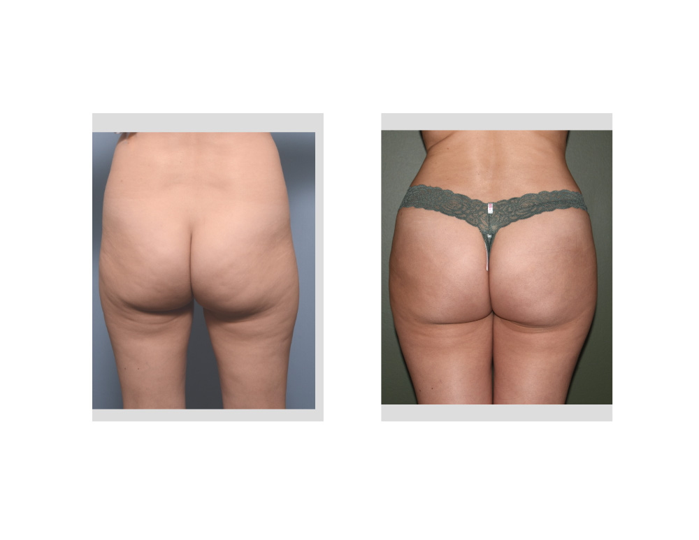 Case Study: Brazilian Butt Lift - Explore Plastic Surgery