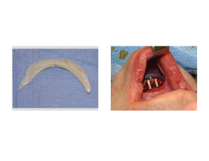 Chin Implant Overlay on Sliding Genioplasty intraop Dr Barry Eppley Indianapolis