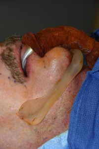 Custom Jawline Implant insertion Dr Barry Eppley Indianapolis