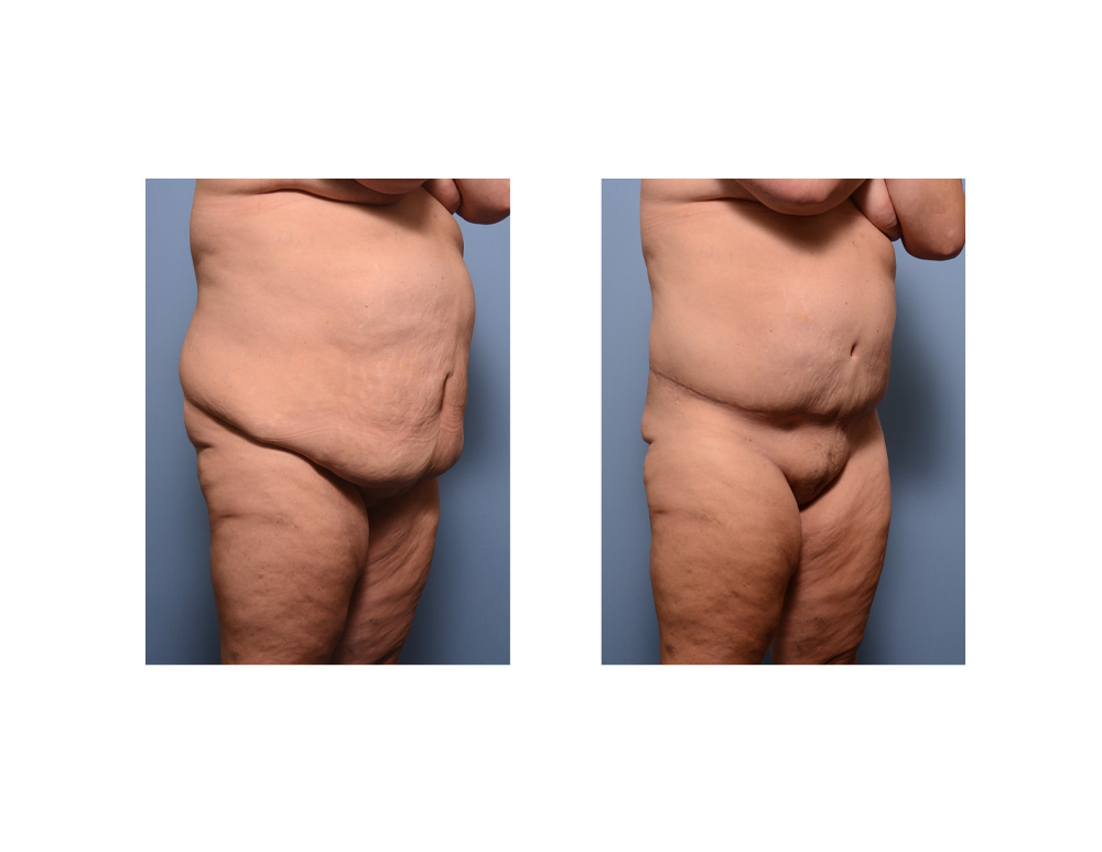 Plastic Surgery Case Study - The Extended Tummy Tuck in the Partial Weight  Loss Patient - Explore Plastic Surgery
