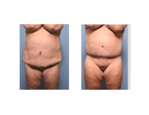 Extended Tummy Tuck results front view Dr Barry Eppley Indianapolis