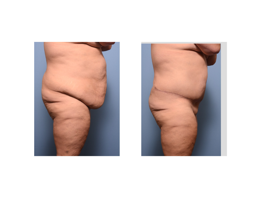 Plastic Surgery Case Study - The Extended Tummy Tuck in the