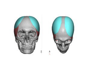 Head Widening Implants design Dr Barry Eppley Indianapolis