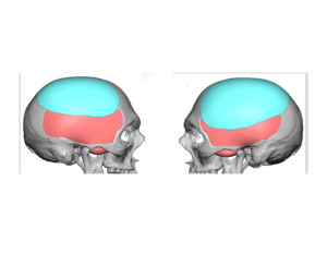 Head Widening Implants design side view Dr Barry Eppley Indianapolis