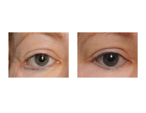 Lower Eyelid Ectropion Repair front view Dr Barry Eppley Indianapolis