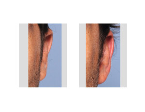 Otoplasty Reversal result left ear bDr Barry Eppley Indianapolis