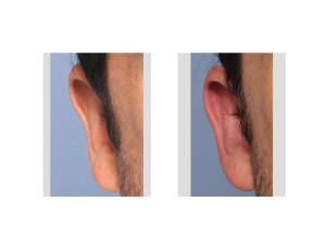 Otoplasty Reversal result right ear Dr Barry Eppley Indianapolis