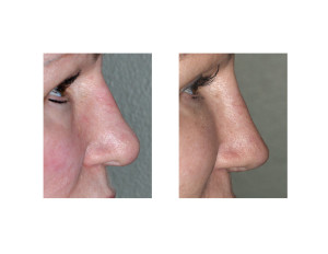 Revisional Rhinoplasty results side view Dr Barry Eppley Indianapolis
