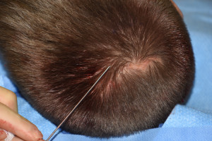 Scalp Scar Release Instrument Dr Barry Eppley Indianapolis