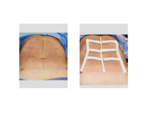 Abdominal Etching dressing intraop front view Dr Barry Eppley Indianapolis