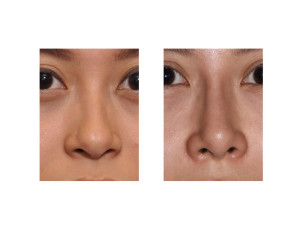 Asian Implant Rhinoplasty result front view Dr Barry Eppley Indianapolis