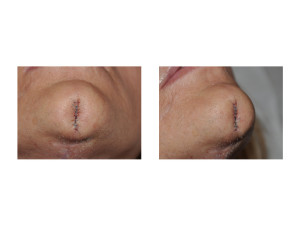 Chin Cleft Creation Surgery intraop Dr Barry Eppley Indianapolis