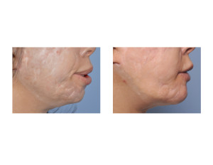 Custom Extended Chin Implant result side view Dr Barry Eppley Indianapolis