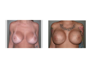 Extreme Breast Augmentation result front view Dr Barry Eppley