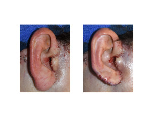 Facelift Earlobe Reduction result Dr Barry Eppley Indianapolis