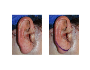 Faceliftv Earlobe Reduction marking Dr Barry Eppley Indianapolis