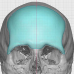 Forehead Implant Design Dr Barry Eppley Indianapolis