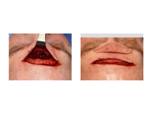 Male Direct Brow Bone Exposure and Bone Flap Removal intraop Dr Barry Eppley Indianapolis