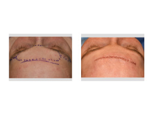 Male Direct Brow Bone Reduction Skin Closure Dr Barry Eppley Indianapolis