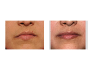 Mouth Asymmetry Surgery result Dr Barry Eppley Indianapolis