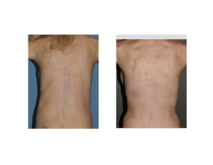 Waistline Narrowing by Rib Removal Surgery results back view Dr Barry Eppley Indianapolisjpg