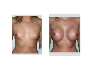 Wide Spaced Breast Augmentation result front view Dr Barry Eppley Indianapolis