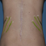 rib removal markings Dr Barry Eppley Indianapolis_edited-1