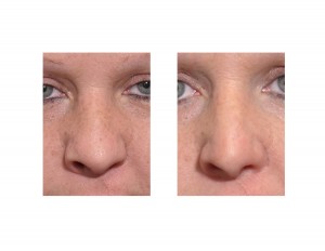 Adult Cleft Rhinoplasty result front view Dr Barry Eppley Indianapolis