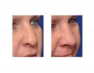 Adult Cleft Rhinoplasty result oblique view Dr Barry Eppley Indianapolis