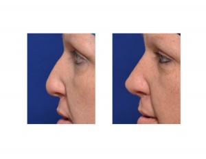 Adult Cleft Rhinoplasty result side view Dr Barry Eppley Indianapolis