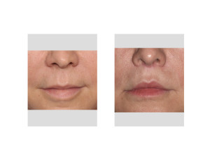 Cali Lip Lift results front view Dr Barry Eppley Indianapolis