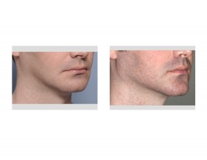 Chin and Jaw Angle Jawline Augmentation result oblique view