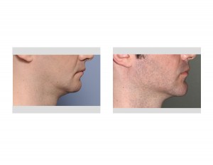 Chin and Jaw Angle Jawline Augmentation result side view