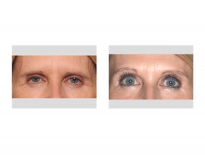 Female Pretrichial Browlift result front view Dr Barry Eppley Indianapolis