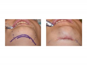 Incision for Submental Chin Reduction Dr Barry Eppley Indianapolis