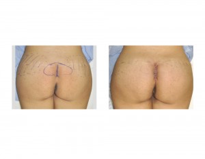 Intraoperative Intramuscular Buttock Implant results 230cc