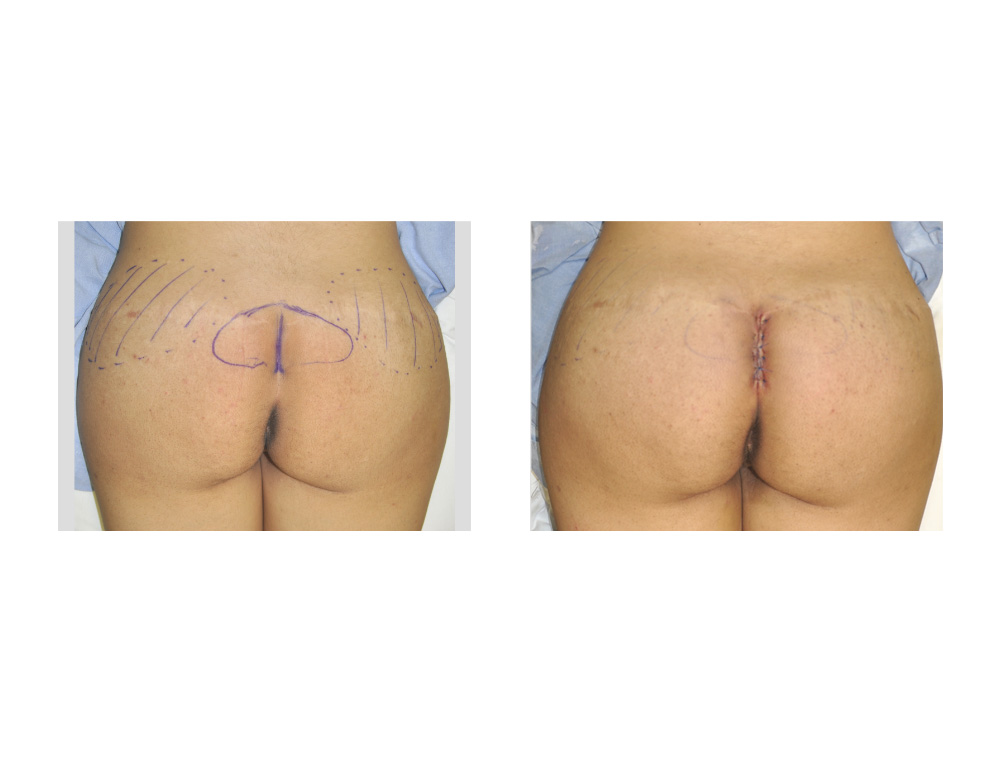 Plastic Surgery Case Study - Natural Contour Buttock Implants - Explore Plastic  Surgery