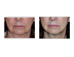 Kybella Injections for Jowls result front view Dr Barry Eppley Indianapolis