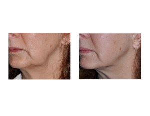 Kybella Injections for Jowls result oblique view Dr Barry Eppley Indianapolis